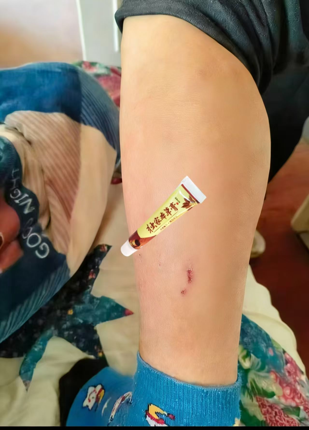 牛皮癣真的太磨人了！
痒起来抓得泛红血丝都不解恨，反复折腾太闹心
du家本草膏直接安排上
草本的超温