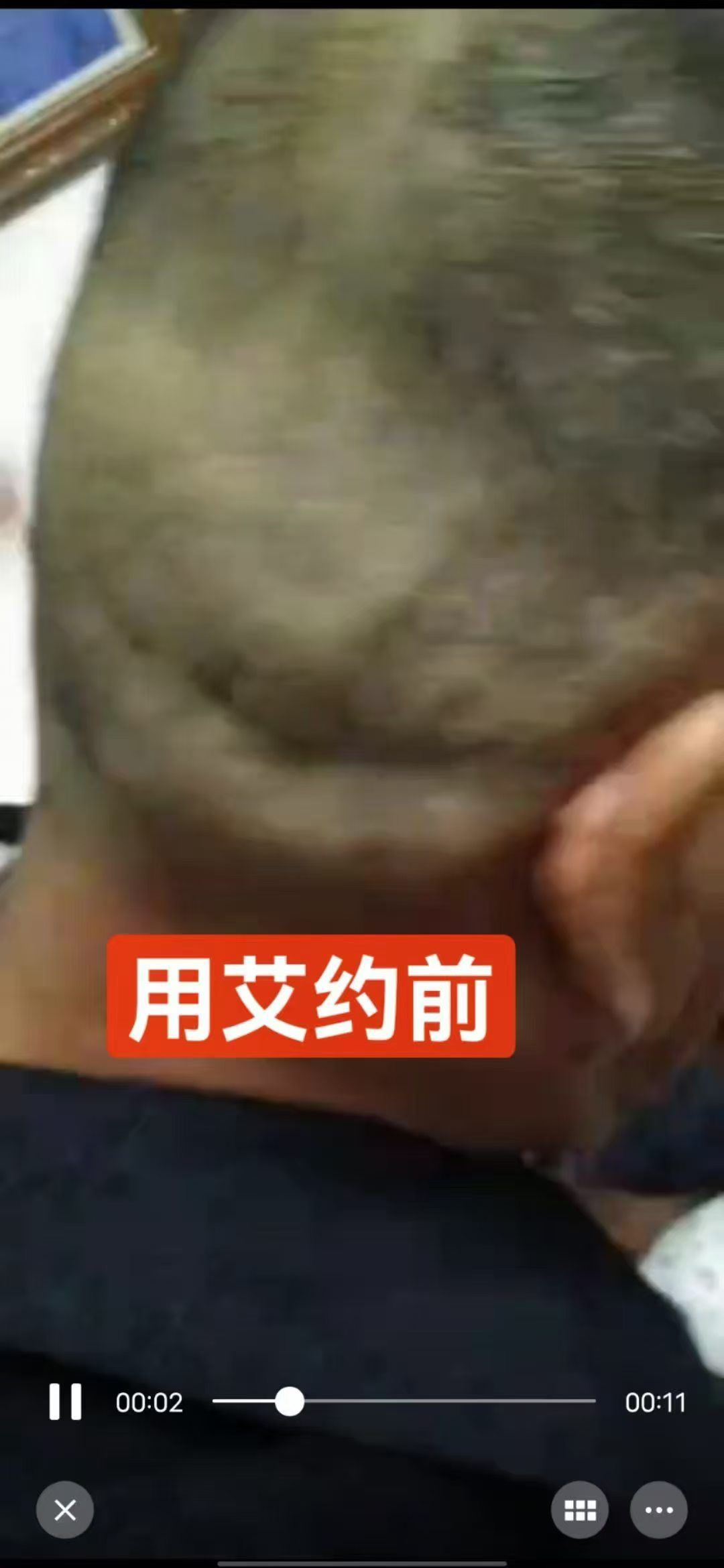 【头部淤堵，用艾约好评】
晓云老爸说话反应好慢，剪光头才发现头部堵了，用艾约后，头部平了说话也正常了