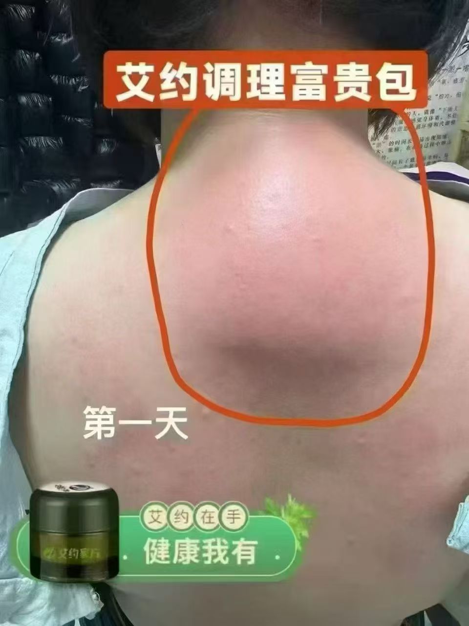 ✅富贵包调理好评反馈。
顾客富贵包花了一万多，都没看到效果，用艾约+手法调理6天，肉眼可见变小，艾约