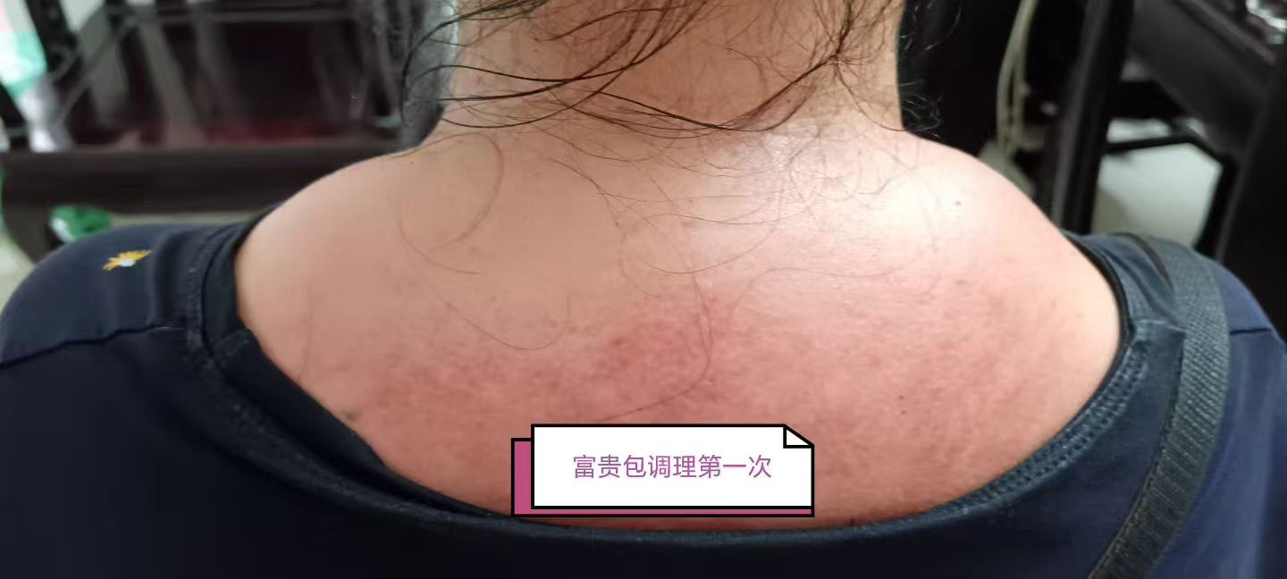 富贵包对比图[烟花][烟花][烟花]
美女的富贵包之前是硬硬的，通过来工作室帮美女调理富贵包第三次软