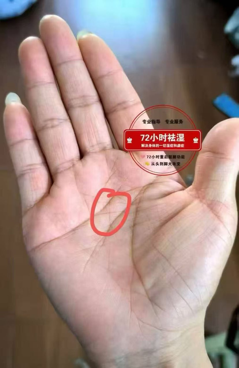 今日手诊：当一线二线间出现十字纹的时候，就说明心脏供血不足，就容易出现胸闷、气短、心悸、胸痛等一系列