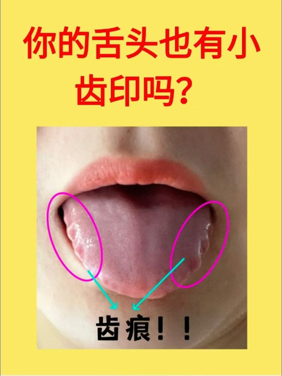 舌头有齿痕，别不当回事！