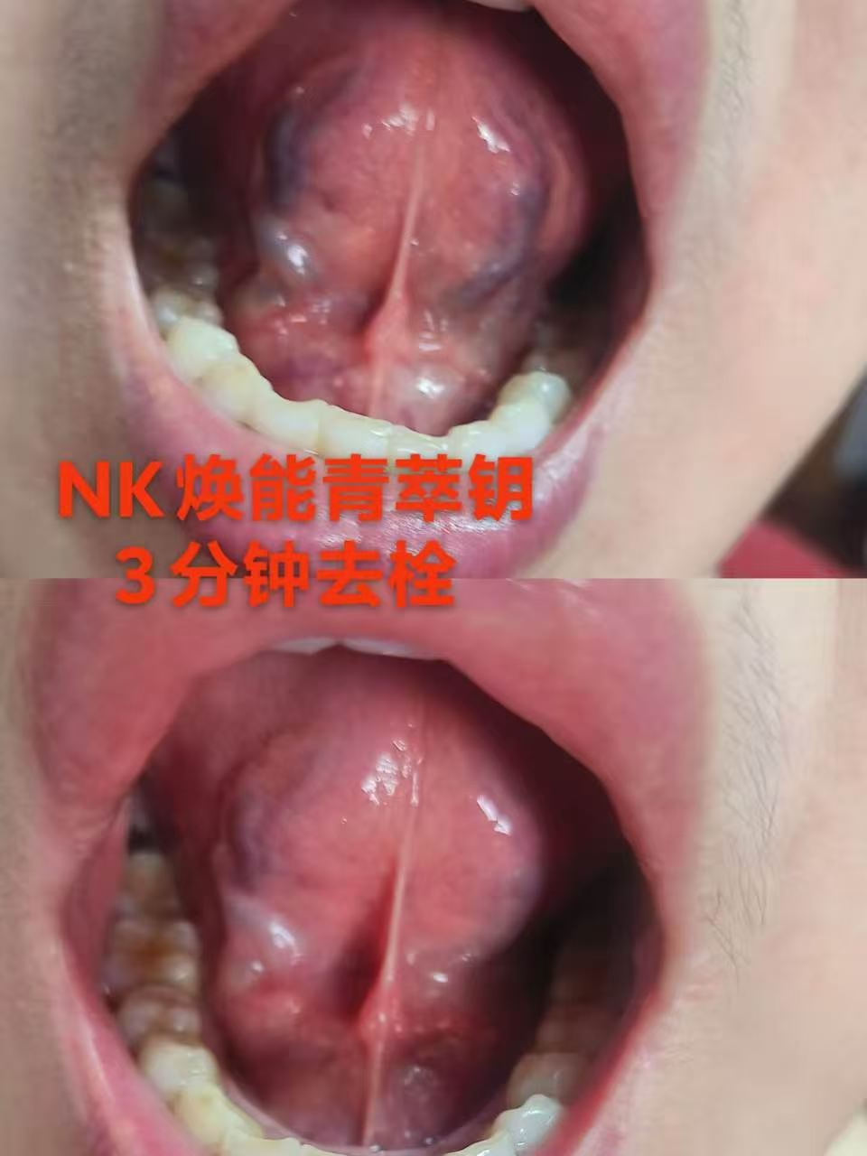 🔥NK内源性干细胞诱导肽🔥
🌹拥有技术发明专利🌹
 头晕、乏力、循环差？淤堵是元凶！
舌下溶栓核心技