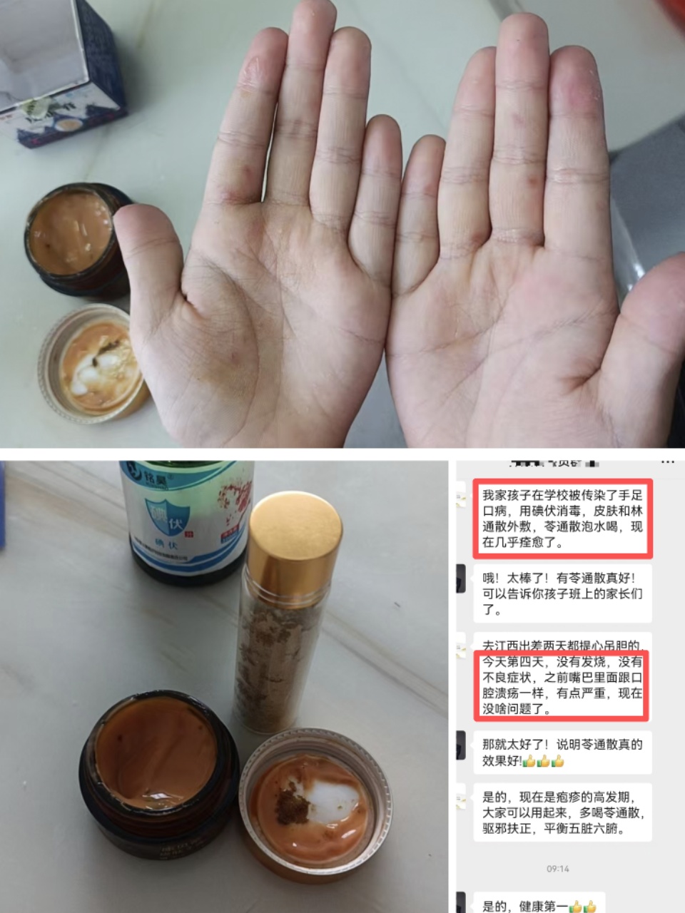 换季疱疹高发期，客户孩子患手足口病，使用#康贝蒂 苓通散皮肤膏外涂➕苓通散内服，未发烧未加重且疱疹有